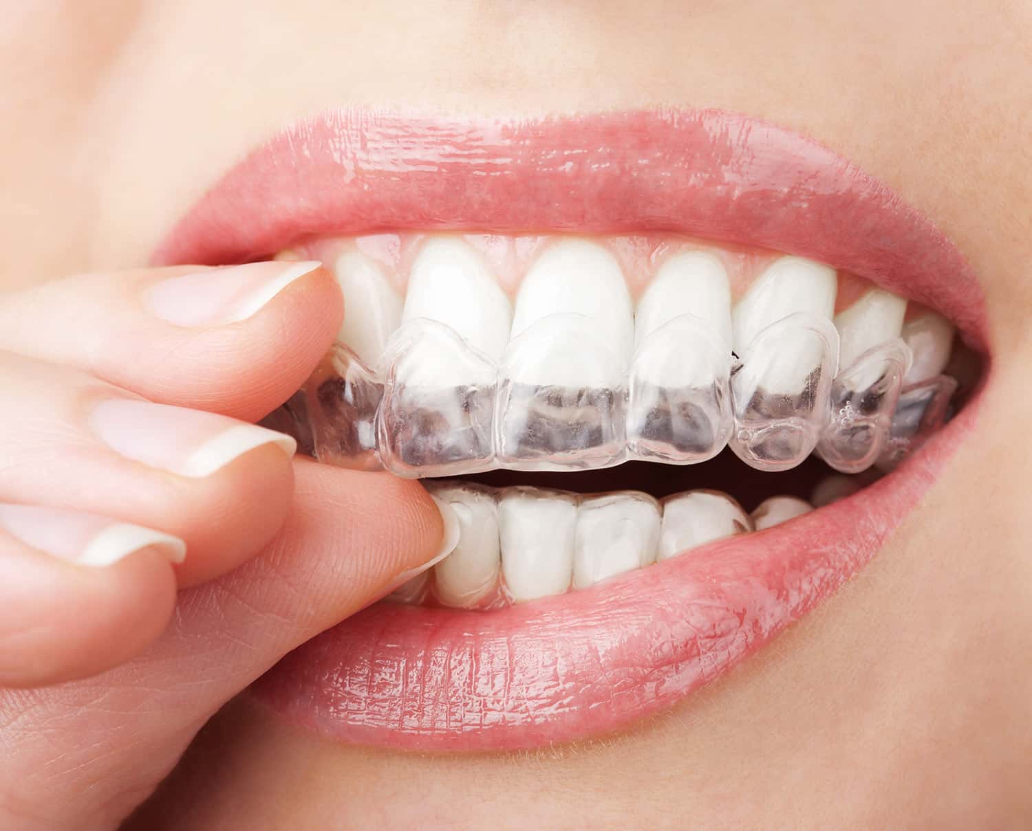 Invisible Braces and Invisalign - Austin Orthodontist - RJ Orthodontics