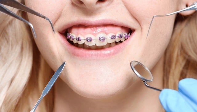 Orthodontist in Austin, TX showing teeth with braces and tools for white spot prevention