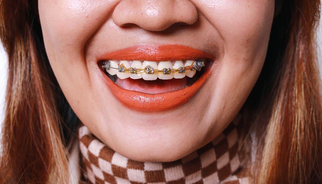 Close-up of adult braces on smiling patient | Orthodontist in Austin, TX